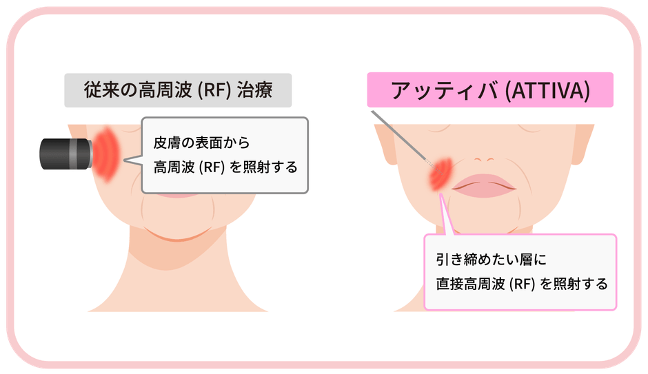 従来の高周波とATTIVA(アッティバ)の違い