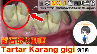 世界No.1動画再生数！YouTuber歯科医Takaが 歯医者の日(8月18日)に全世界への歯の健康動画キャンペーン開催