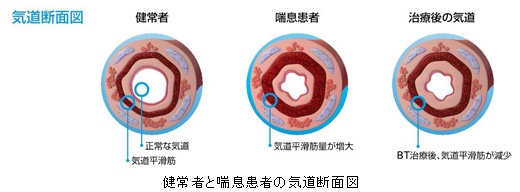 健常者と喘息患者の気道断面図