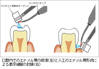 口腔内でのエナメル質の修復(左)と人工のエナメル質形成による象牙細管の封鎖(右)