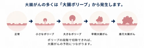 大腸がんは予防できる数少ないがんです