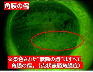 コロナ禍の花粉症シーズン本格化！“目こすり”に要注意 　角膜が傷つく＆手指消毒液が目に入るリスク