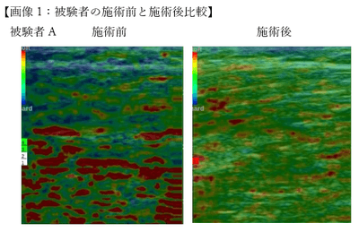 超音波エコー機器「エラストグラフィー」でも筋弛緩効果が認められています(固い筋肉＝青,バランスの良い筋肉＝緑,弱化した筋肉＝赤)