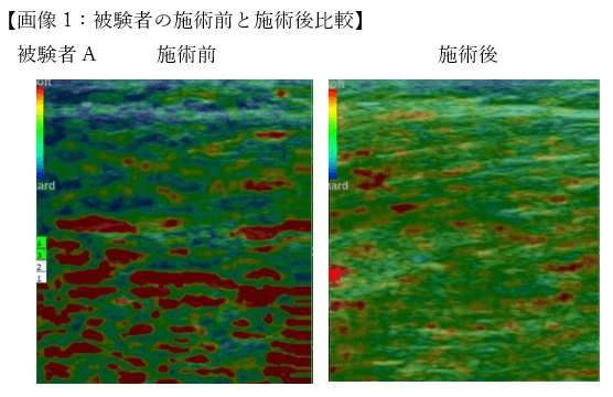 超音波エコー機器「エラストグラフィー」でも筋弛緩効果が認められています(固い筋肉＝青&#44;バランスの良い筋肉＝緑&#44;弱化した筋肉＝赤)