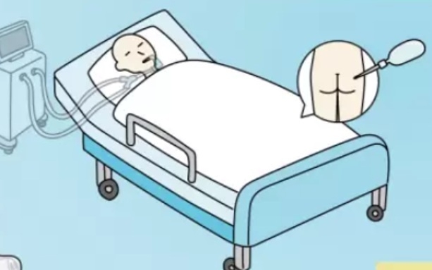 EVA腸換気法