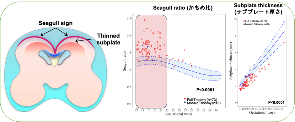 ダウン症の脳ではかもめが羽を広げた様な脳表面の形(かもめサイン、Seagull sign)と脳の薄いサブプレート(Thinned subplate)が特徴的です(左図)。ダウン症のある胎児では、かもめ比とサブプレート厚さの傾向は類似していますが、一人ひとり違う値を示しています。