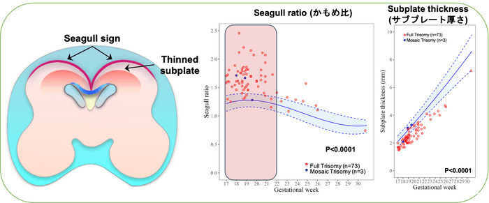 ダウン症の脳ではかもめが羽を広げた様な脳表面の形(かもめサイン、Seagull sign)と脳の薄いサブプレート(Thinned subplate)が特徴的です(左図)。ダウン症のある胎児では、かもめ比とサブプレート厚さの傾向は類似していますが、一人ひとり違う値を示しています。