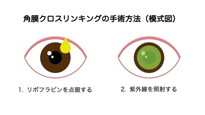 角膜クロスリンキングの手術方法
