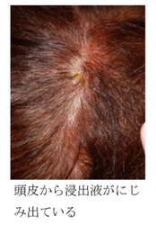 消費者庁が警鐘を鳴らすヘアカラーによる皮膚トラブル対策 　最新の“染めない白髪ケア”が話題になった 美容室FORMEが東京 自由が丘に1月15日オープン