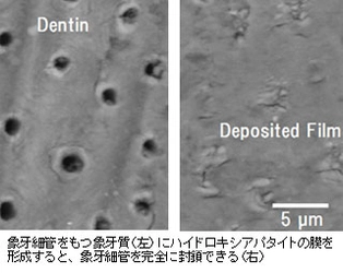 レーザーを用いたエナメル質修復の新技術　生物理工学部　教授・本津 茂樹らの研究成果