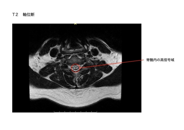脊髄のMRI画像。軸位断面で脊髄の異常信号を示している