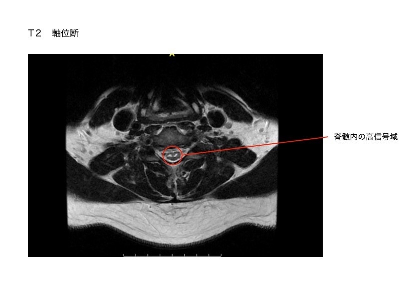 脊髄のMRI画像。軸位断面で脊髄の異常信号を示している