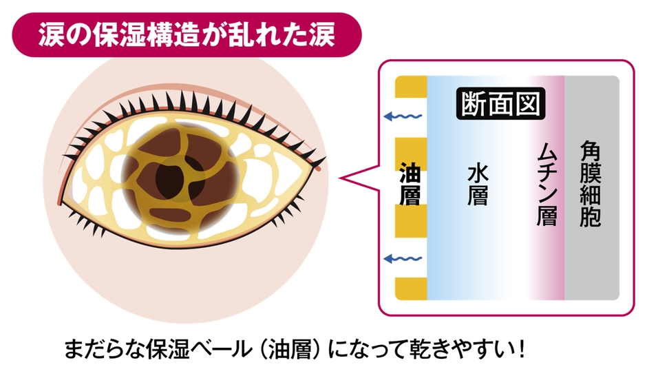 図8) 涙の保湿構造が乱れた涙