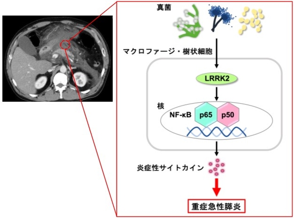 重症急性膵炎の発症メカニズム