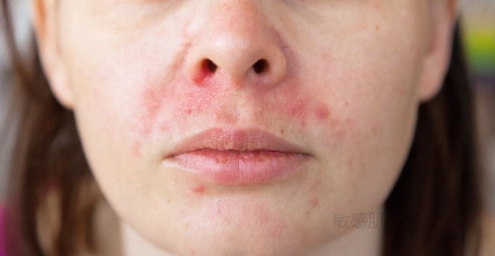 【皮脂・赤み・痒み】脂漏性皮膚炎の正しい洗顔・保湿のポイントを医学博士が解説