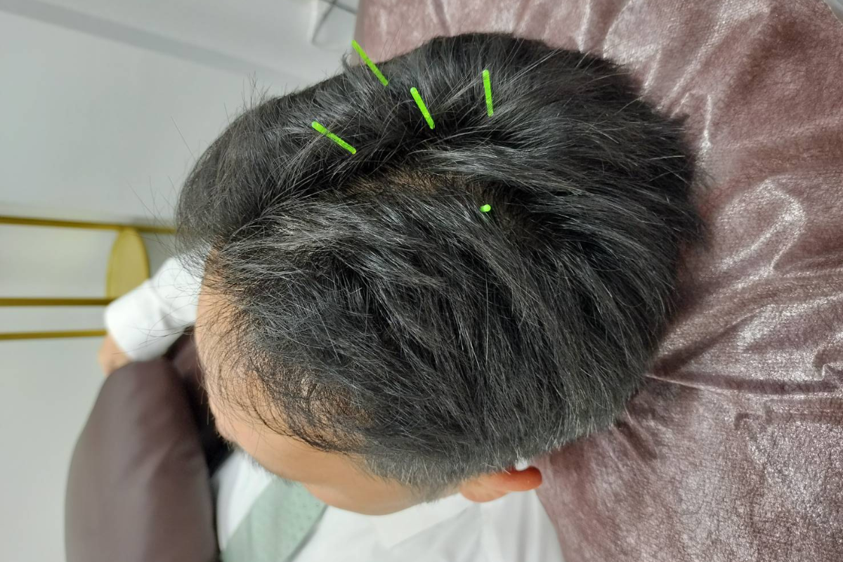 国家資格者による鍼灸とヘッドケアを融合した独自の施術。出張時も企業の要望に合わせ、本格的な鍼施術によるコンディショニングが可能。