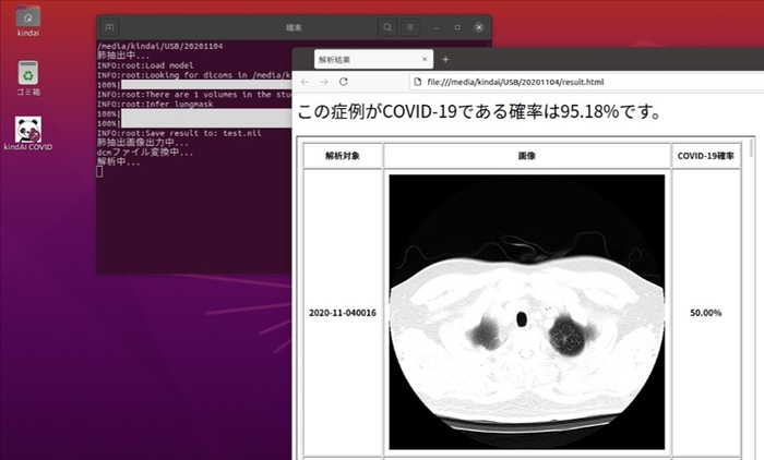 新型コロナウイルス感染症による肺炎症状の自動診断システムの解析画面