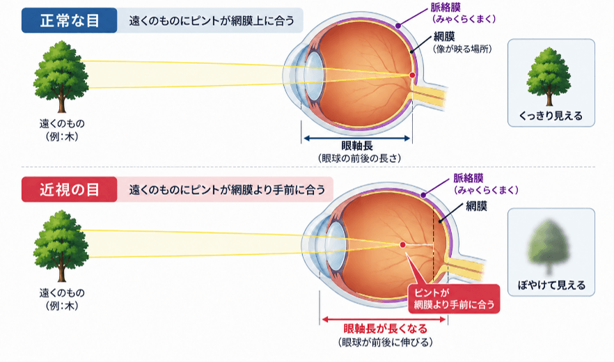 正常な目と近視の目