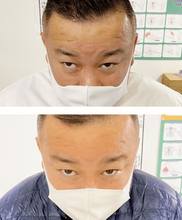 上から施術前と施術後