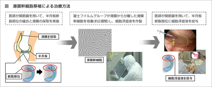 滑膜幹細胞を用いた再生医療