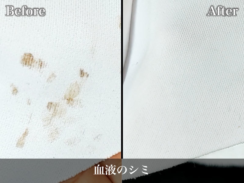 血液のしみ抜きビフォーアフター