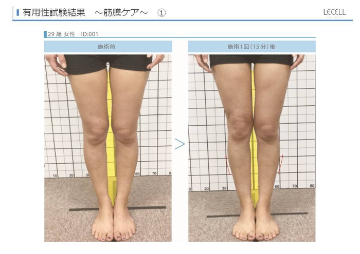 レセル ボディによる有用性試験結果(筋膜リリース)の一例