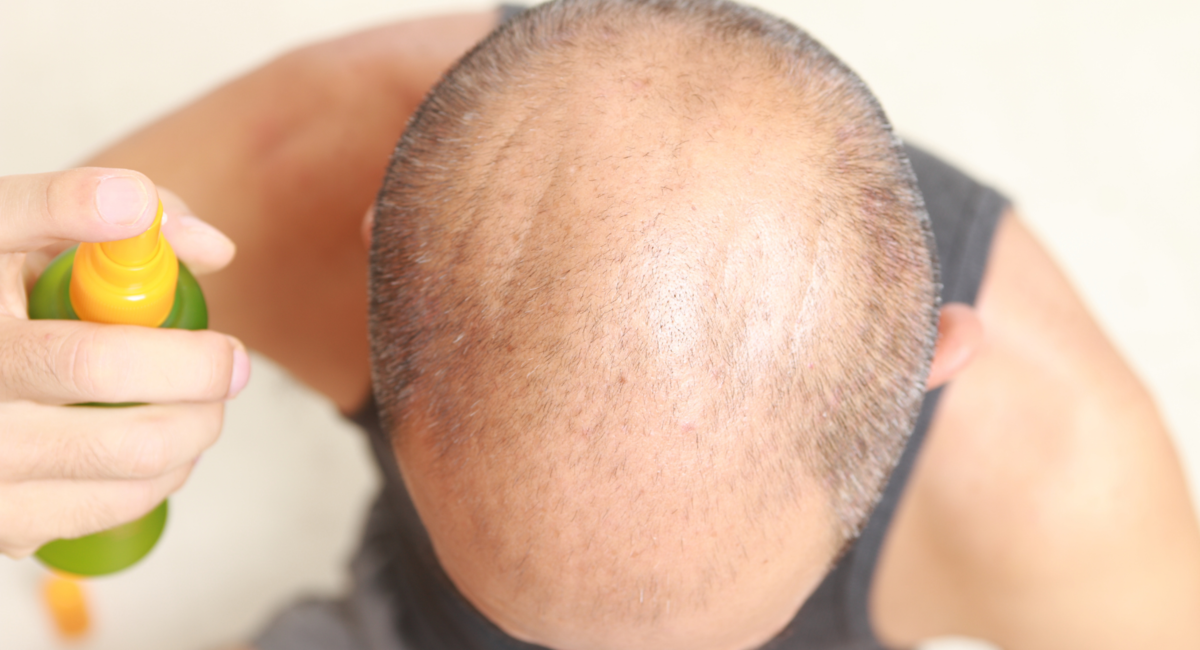 毛髪再生の市場規模は2027年までに120.5億米ドルに達する見込み