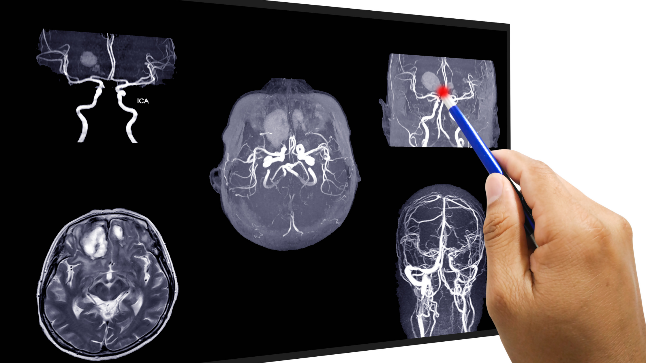 頭蓋内動脈瘤の市場規模は2028年までに22億2000万米ドルに達する見込み