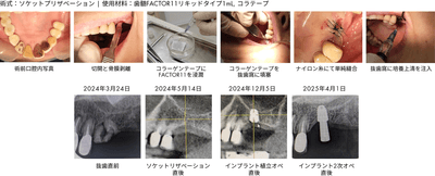 ソケットプリザべーション症例