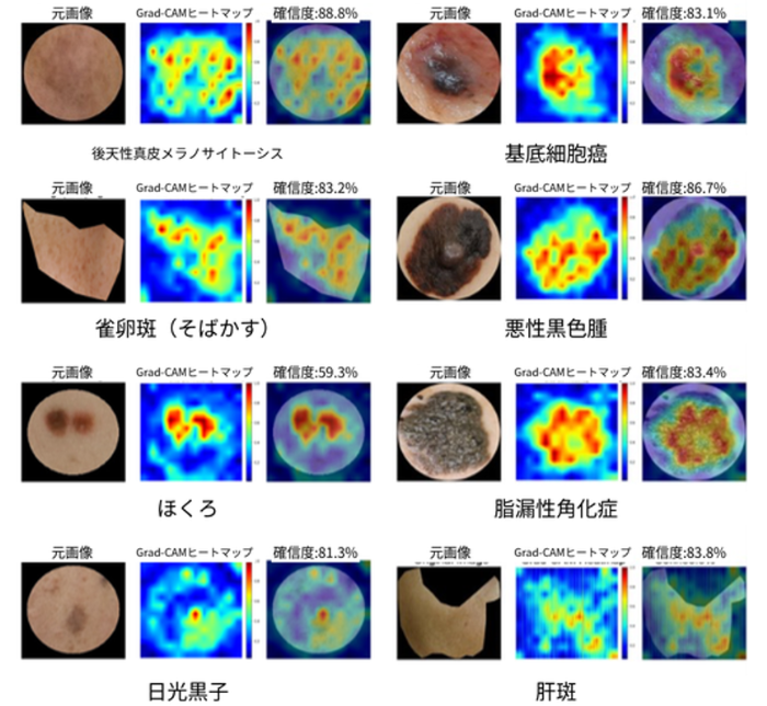 8種類の色素性皮膚病変を高精度で判別 診断根拠を可視化するAIを開発、医療現場への導入に期待