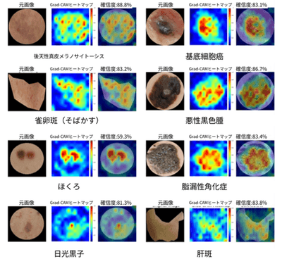 AIが「どこを見て診断したか」を示すヒートマップ