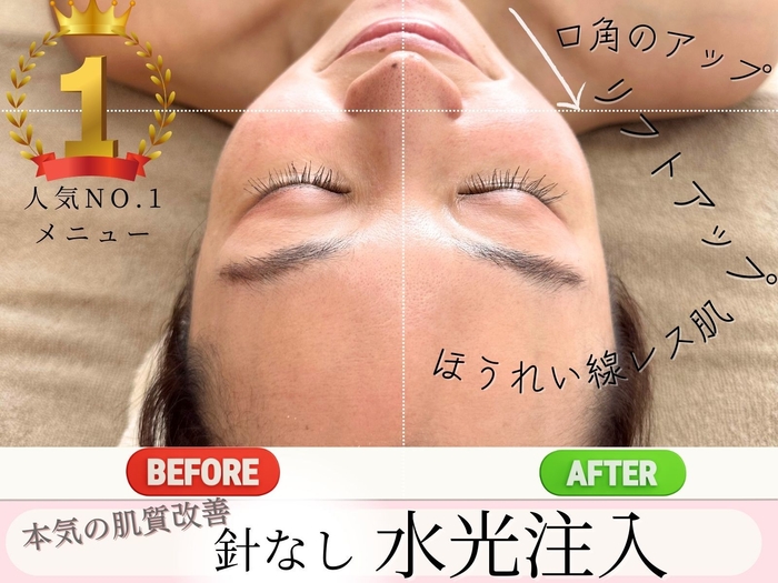 効果実感 無針水光注入