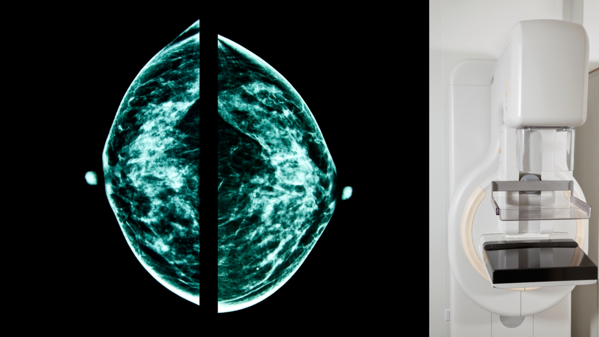 世界のマンモグラフィーワークステーション市場の範囲、調査、成長予測、2028年までの調査レポート