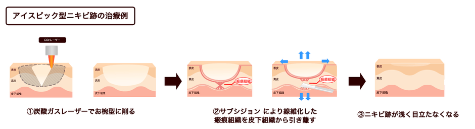 アイスピック型ニキビ跡の治療例
