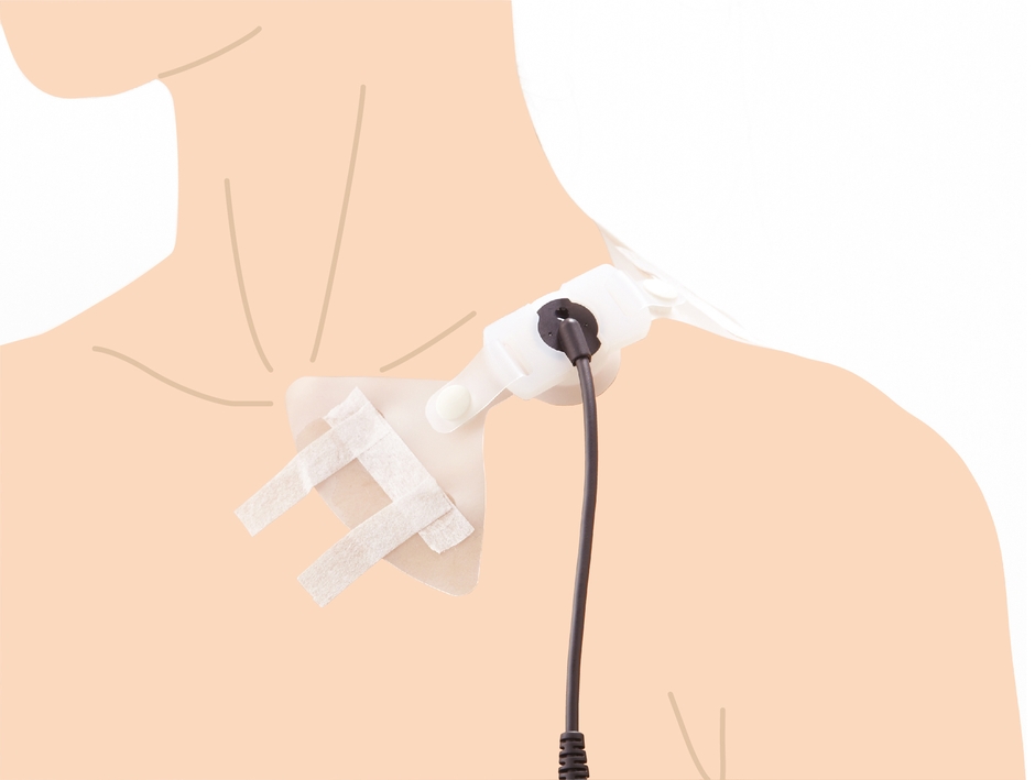 ［使用例］鎖骨骨折治療