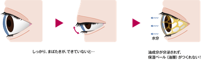 まばたき不全