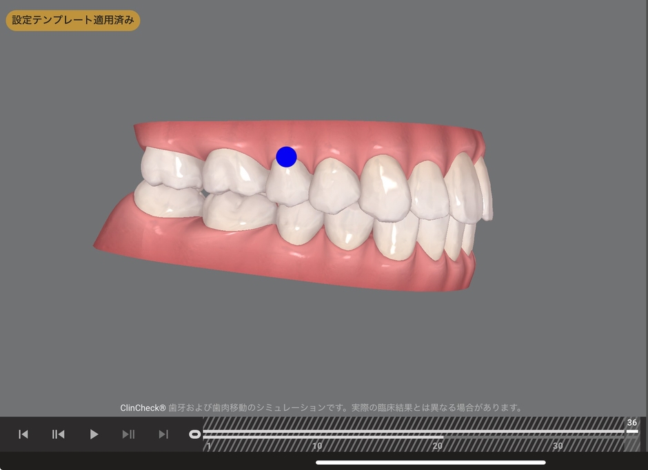 奥歯がまだ理想的なかみ合わせではないが、まずは患者様が気にされている「出っ歯」の改善をメインにした矯正治療(治療後イメージ)