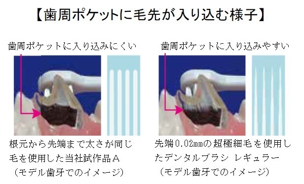 歯周ポケットに毛先が入り込む様子