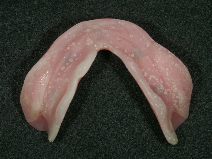 汚れが蓄積された総入れ歯