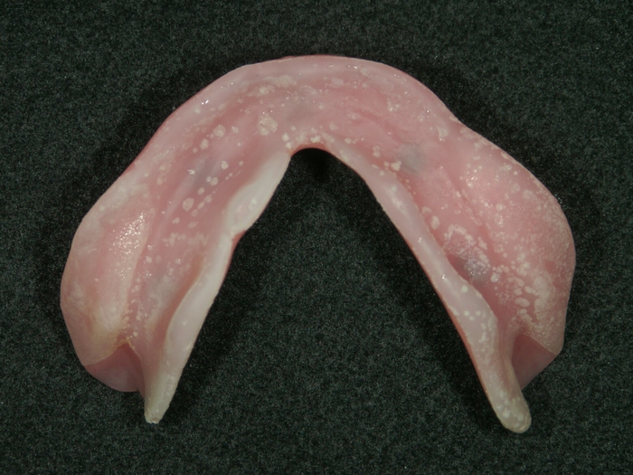 汚れが蓄積された総入れ歯