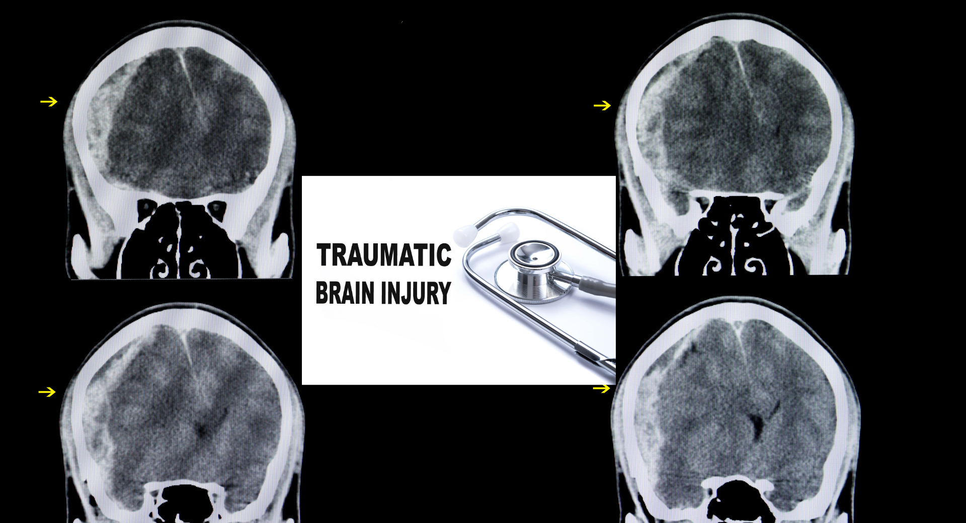 外傷性脳損傷の評価・管理装置の市場規模は、2027年までに54億3000万米ドルに達する見込み