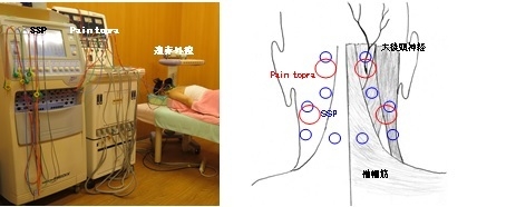 治療写真と低周波電気刺激部位例