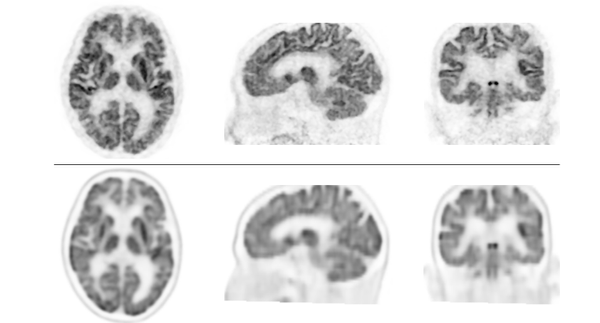 上段：本PET装置により得られた脳FDG-PET画像　下段：従来型装置により得られた脳FDG-PET画像　上段の画像の方が分解能が高く、細かいところまでみえる。下段の方は少しぼやけてみえる。