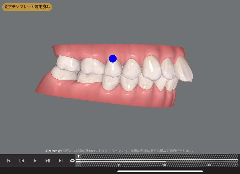 舌や唇の癖により、年齢とともに上の歯並びが前に出てきてしまったケース(治療前)