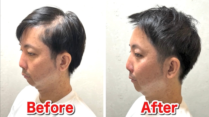 M字薄毛をカットで改善(4)
