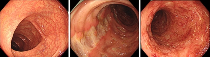 正常な大腸粘膜（左）、クローン病の大腸粘膜（中央）、潰瘍性大腸炎の大腸粘膜（右）