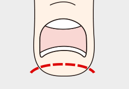 間違った爪切り