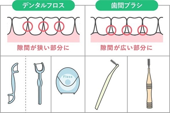 歯間清掃用具の種類と使い分け