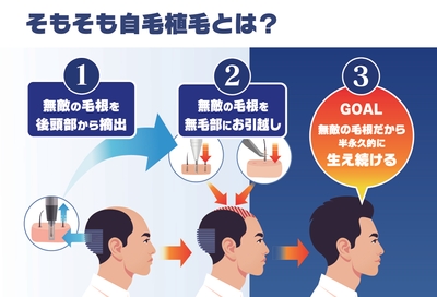 植毛の仕組み