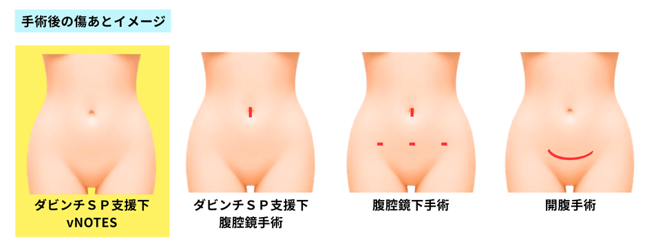 従来手術と比較した創部イメージ(vNOTESでは腹部に傷が残らない)
